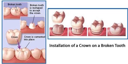 Cracked Tooth Treatment