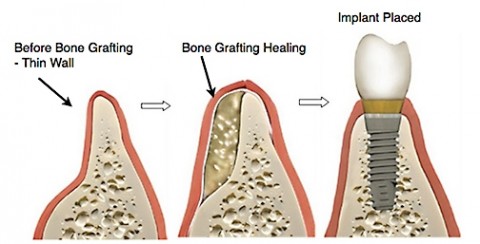 Bone Graft Types