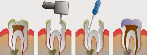 What is a Root Canal Treatment