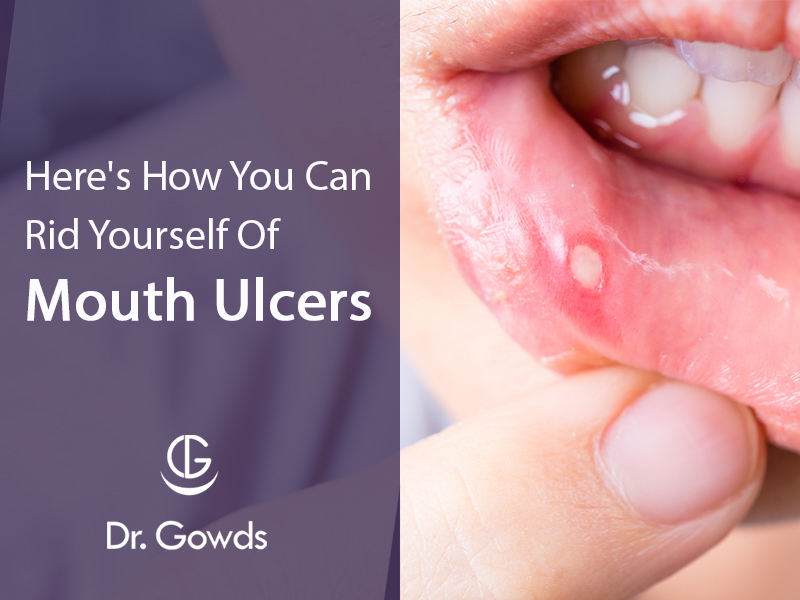 Here’s How You Can Treat Ulcers At Home