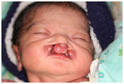 Cleft lip and palate – Slit in the mouth